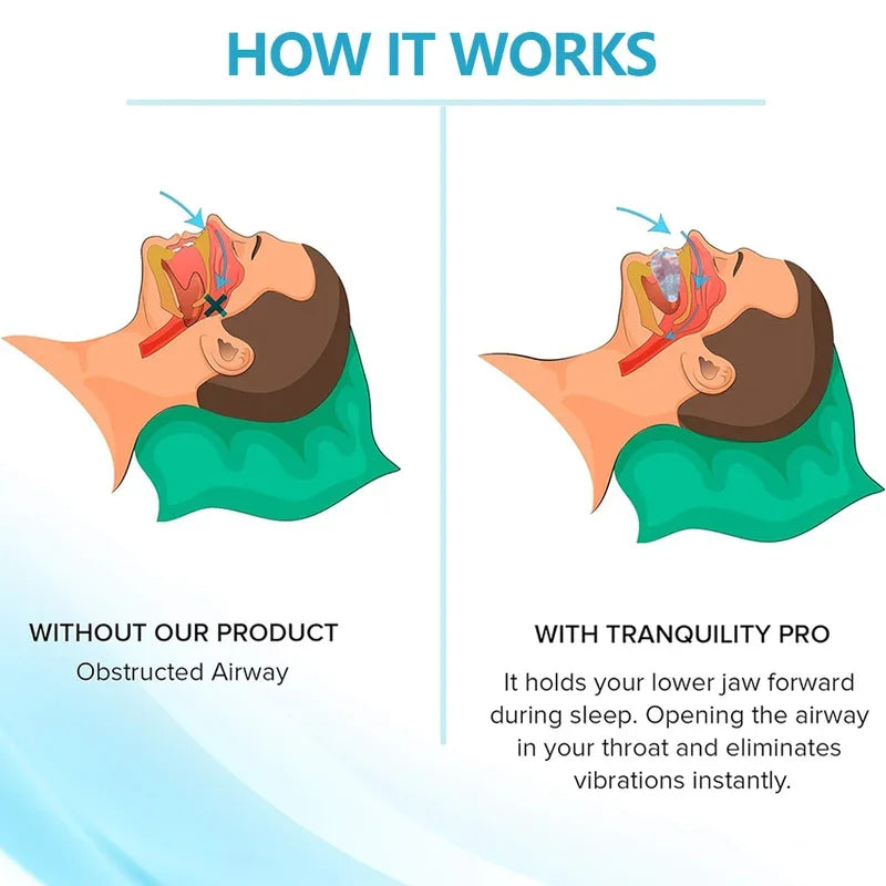 Anti-Snoring Mouth Guard – Sleep Support Mouthpiece for Night Comfort